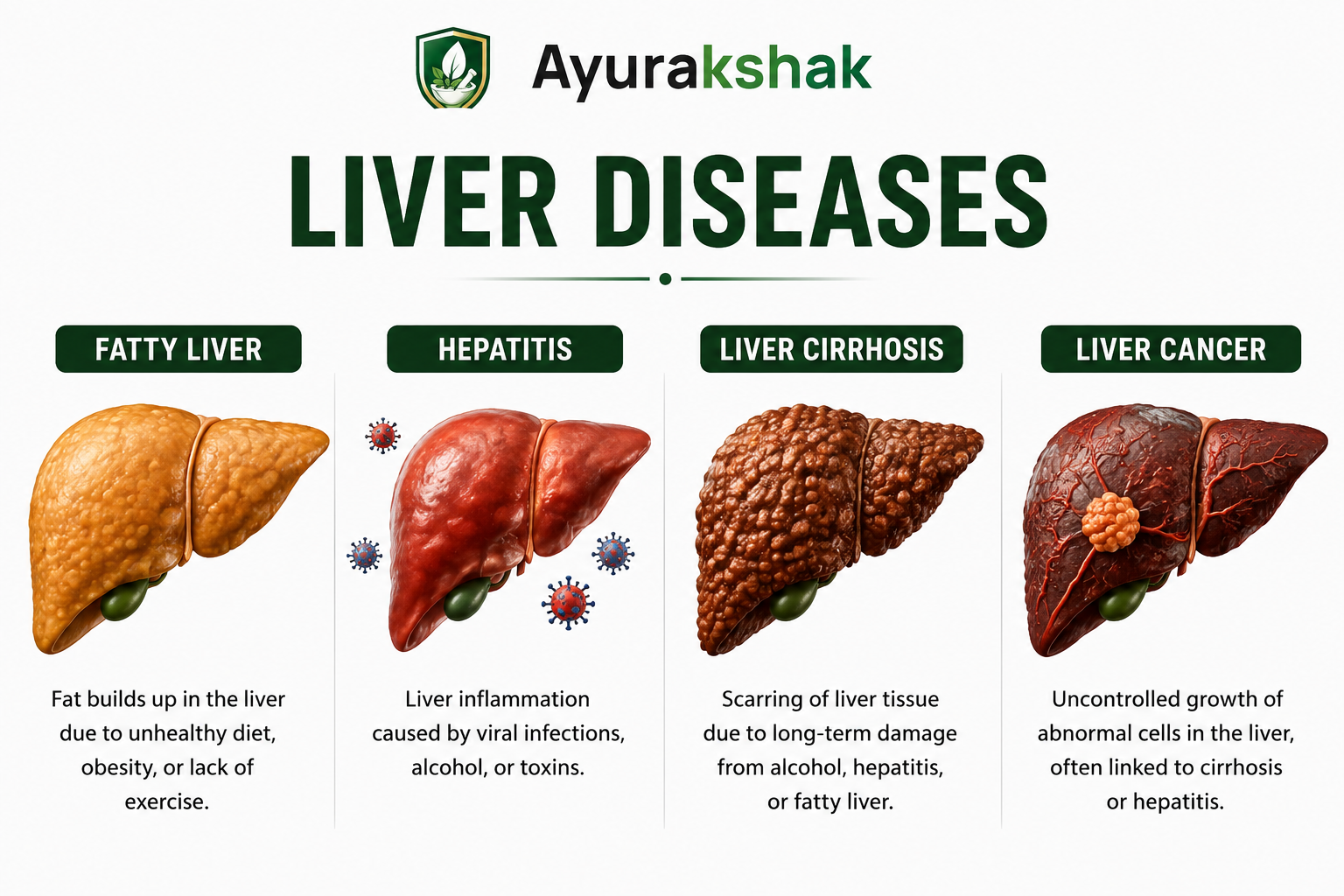 Types of liver diseases — Fatty Liver, Hepatitis, Liver Cirrhosis and Liver Cancer