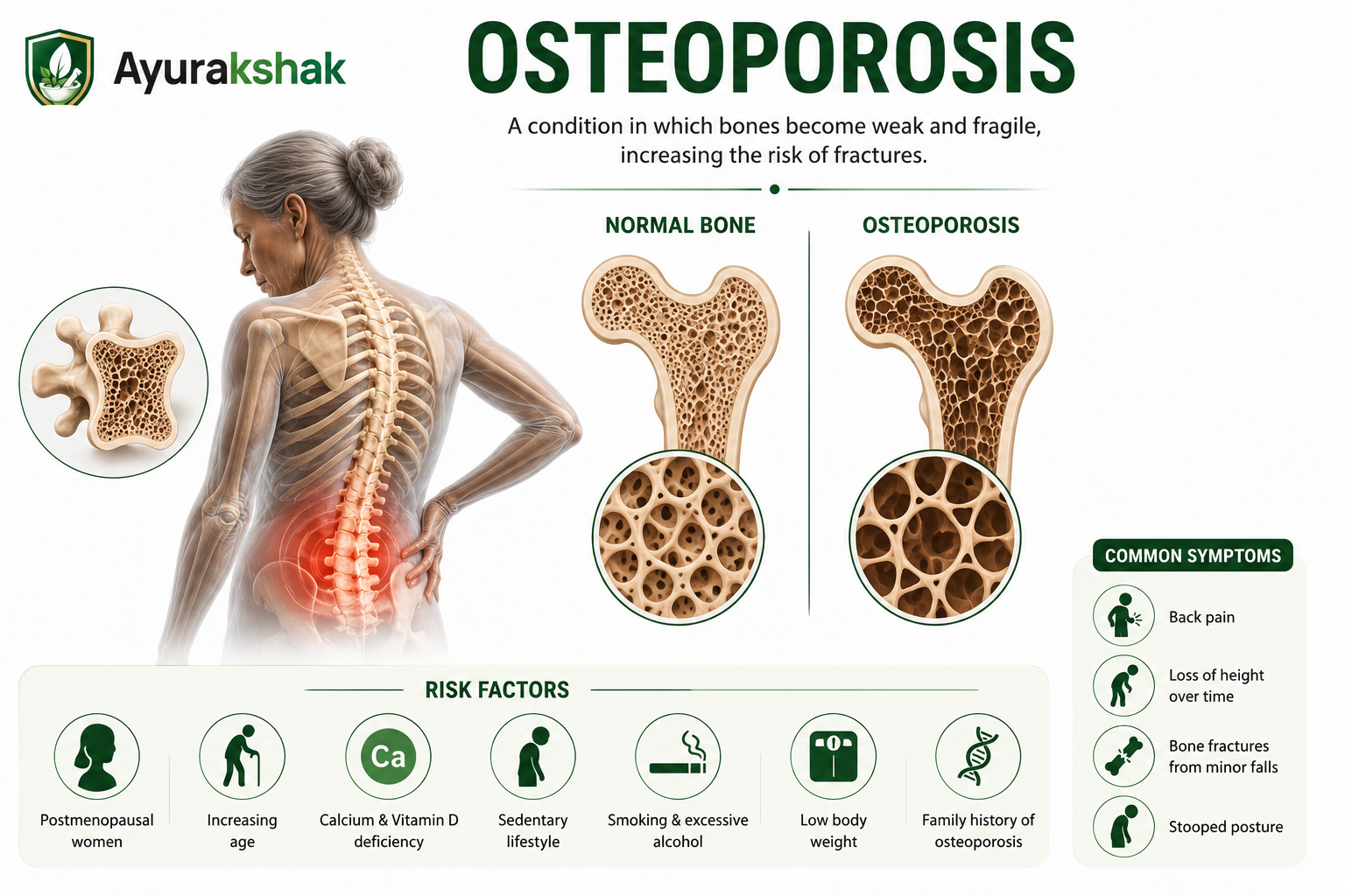 Osteoporosis — normal bone vs osteoporotic bone, risk factors and common symptoms